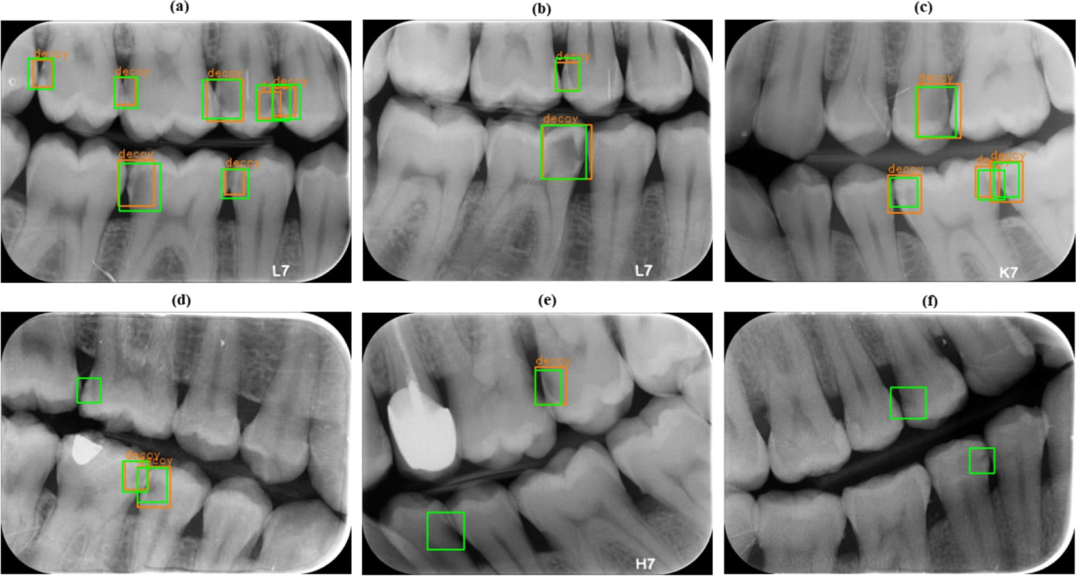 Early Interproximal Caries Detection