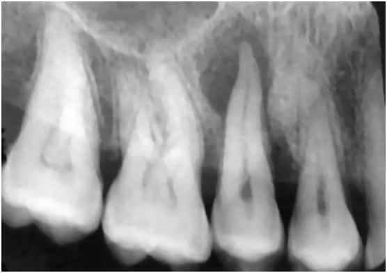 Periapical Pathology Identification